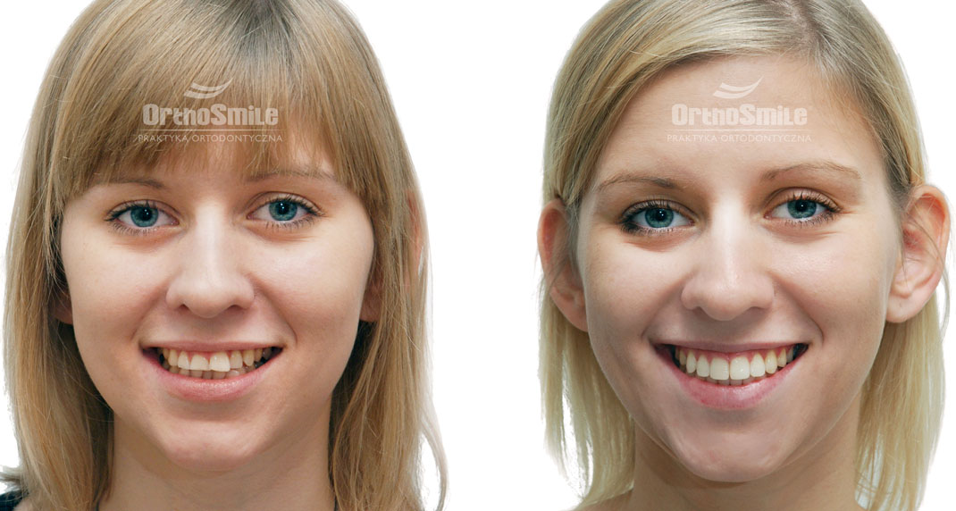 wyniki leczenia ortodontycznego, koronoplastyka pozytywna, ładny prawidłowy zgryz