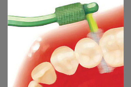 czyszczenie przestrzeni międzyzębowych, szczoteczka międzyzębowa, higiena jamy ustnej, leczenie ortodontyczne